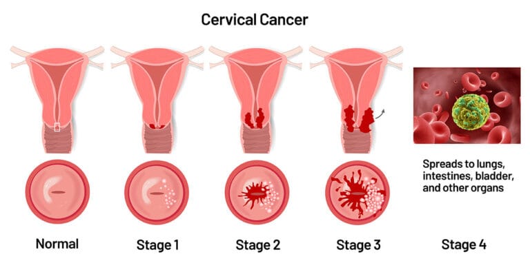 Cervical Cancer Stages Saint Johns Cancer Institute