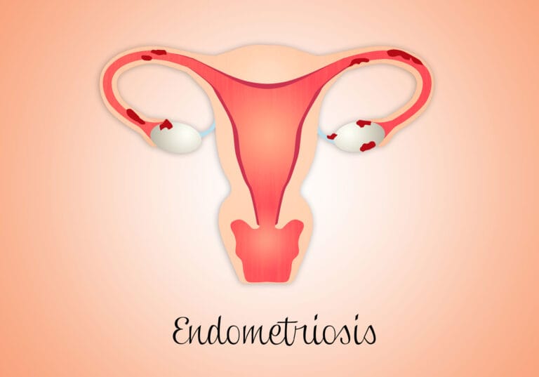 Endometriosis image