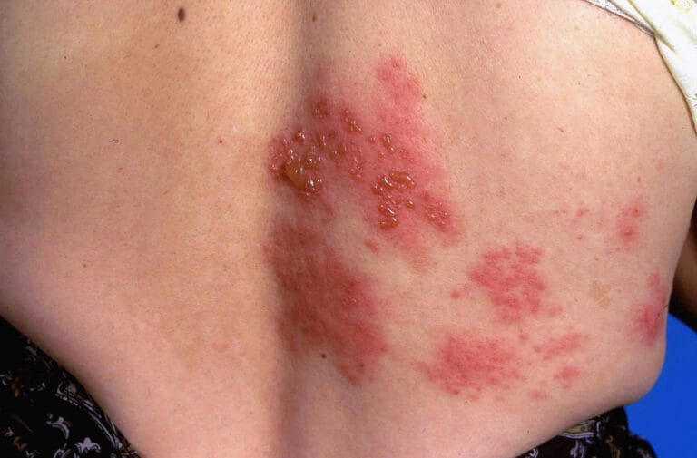 Shingles