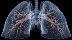 Lung Cancer Image