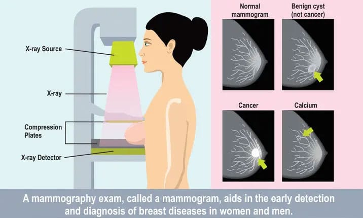 Breast Cancer Mammogram