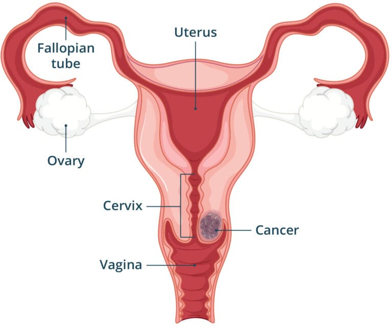 Cervical Cancer Health Direct