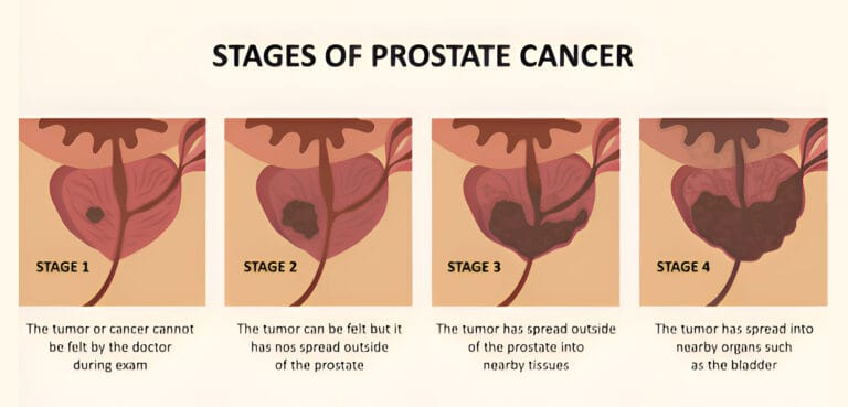 Prostate Cancer Stages